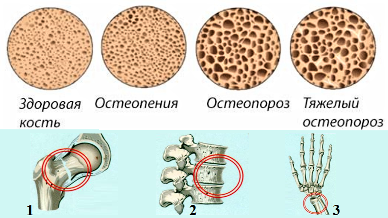 Степени тяжести остеопороза