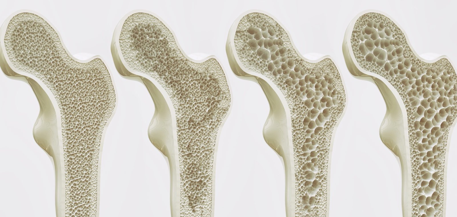 Диффузный остеопороз костей, позвоночника: что это такое, лечение