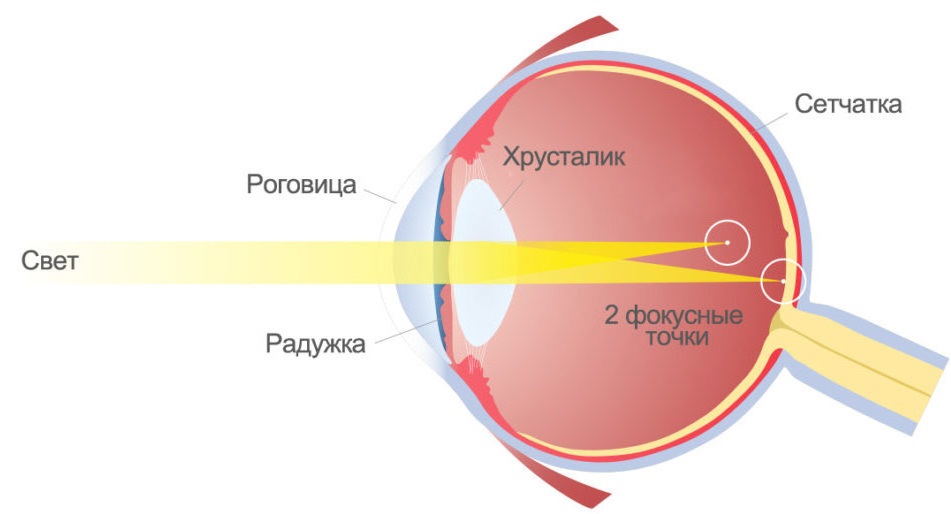 Упражнения для глаз при астигматизме — будет ли эффект? «вороковский.рф»