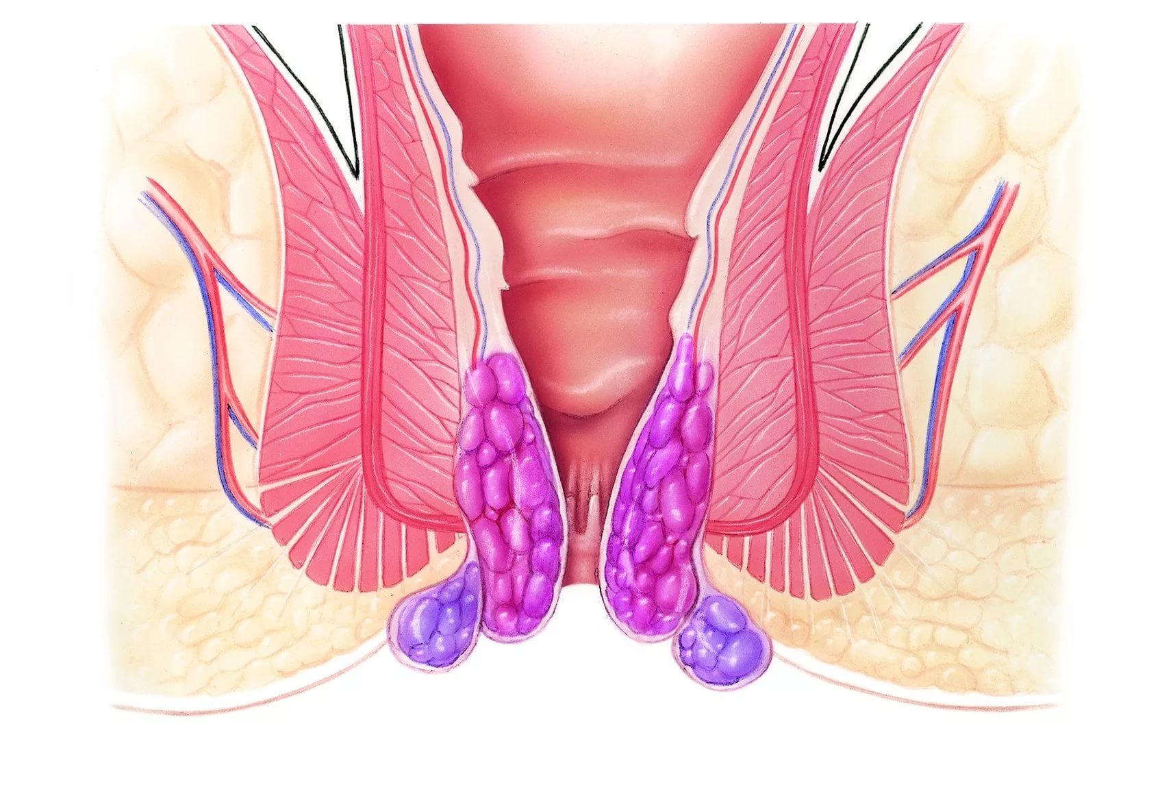 Наружный геморрой - лечение внешних геморроидальных узлов