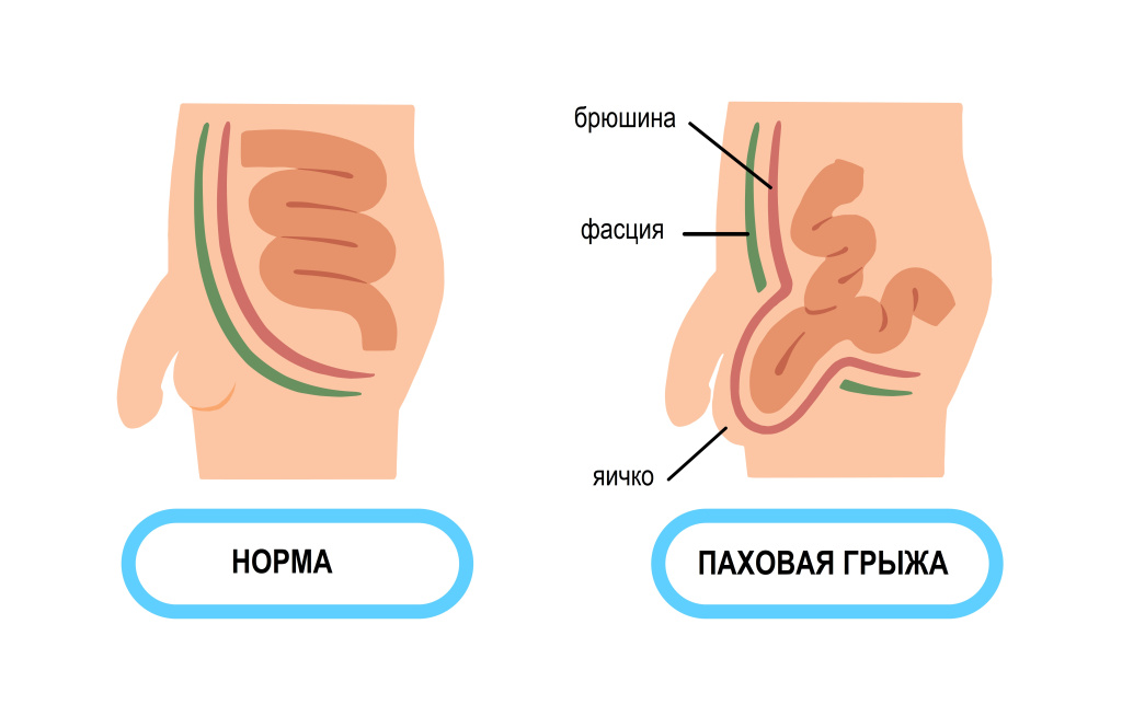 Паховая грыжа