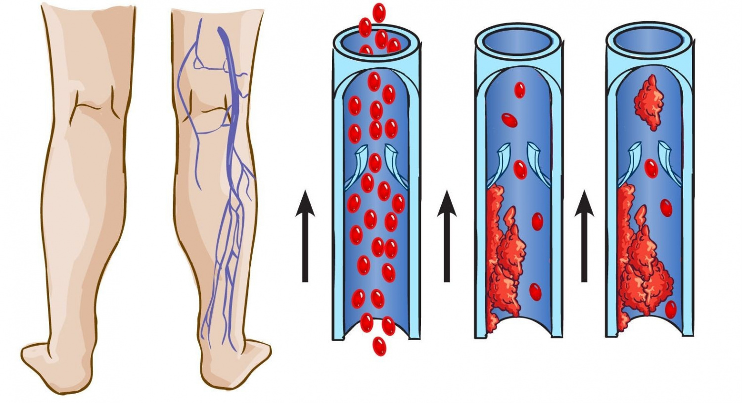 Варикоз - что это, симптомы заболевания, типы, диагностика и лечение