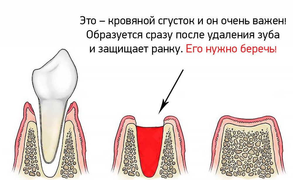 Кровяной сгусток