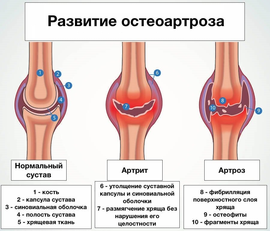 Развитие остеоартроза