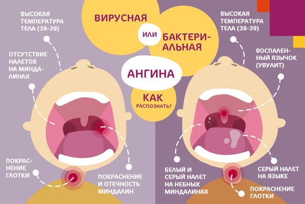 Вирусная и бактериальная ангина