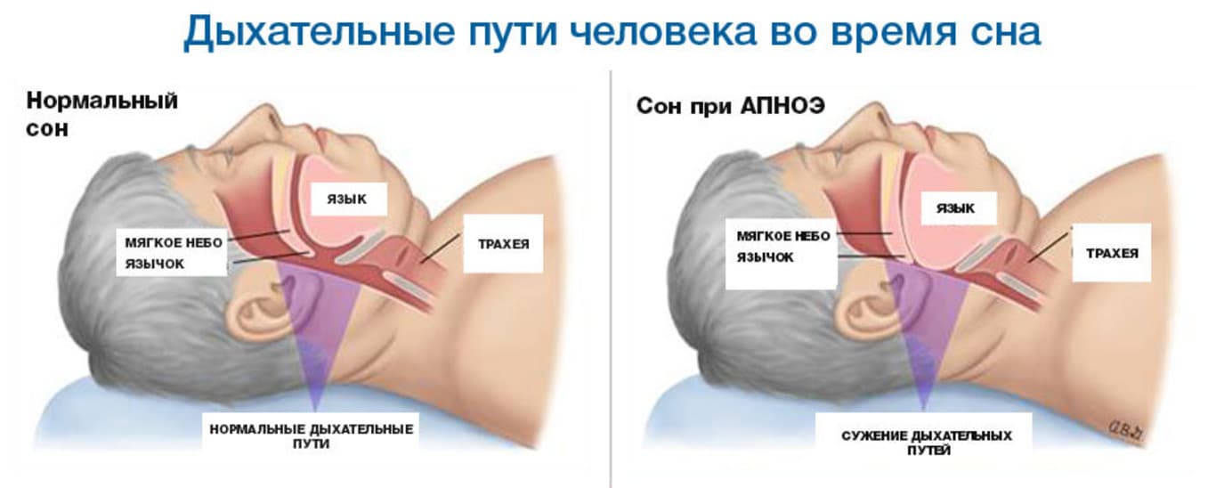 Сон при апноэ