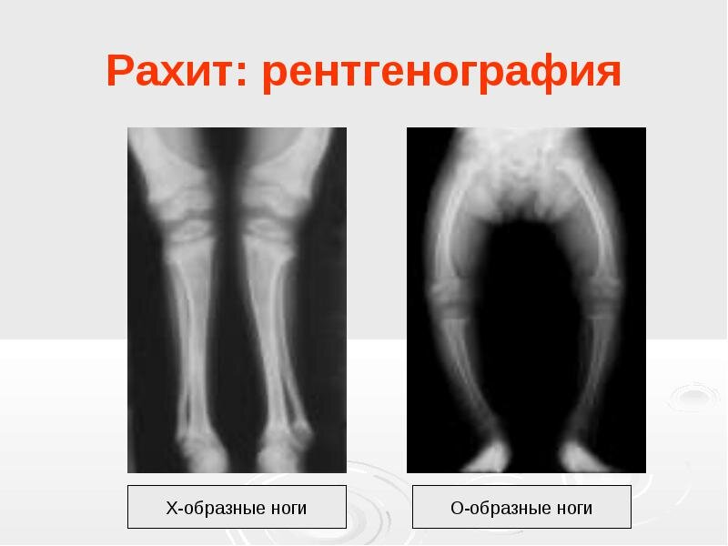 Рахит у детей: симптомы, лечение, профилактика