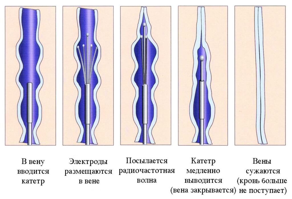 Абляция вен