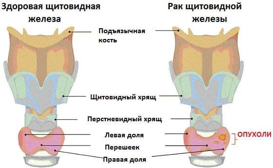 Рак щитовидки