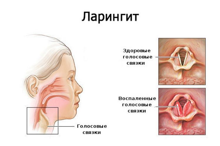 Почему длительно болит горло? Возможные причины и эффективные методы лечения