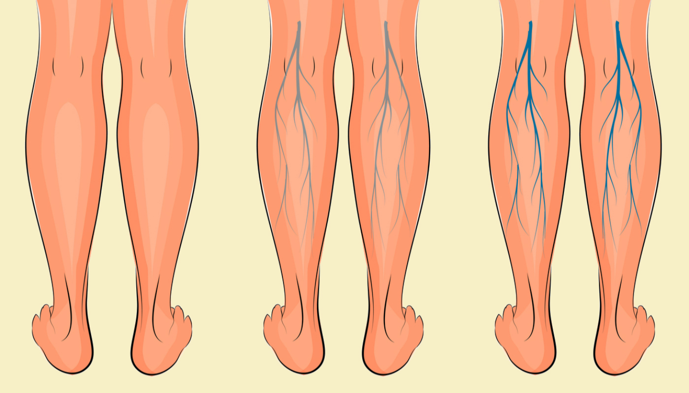 Варикоз - что это, симптомы заболевания, типы, диагностика и лечение