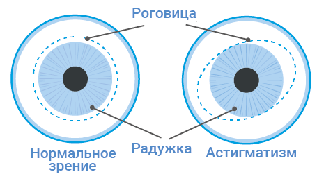 Астигматизм как выглядит картинка