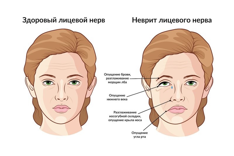 Невриты лицевого нерва | НИИ Склифосовского официальный сайт | Платные услуги