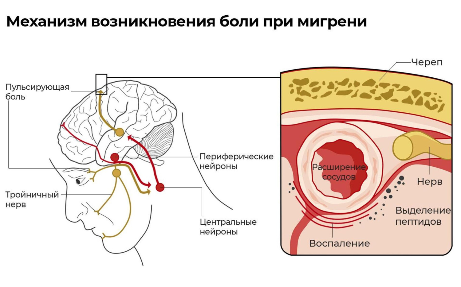 Механизм возникновения боли при мигрени