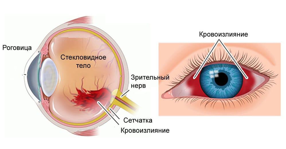 Диагностика и лечение ощущения пелены перед глазами