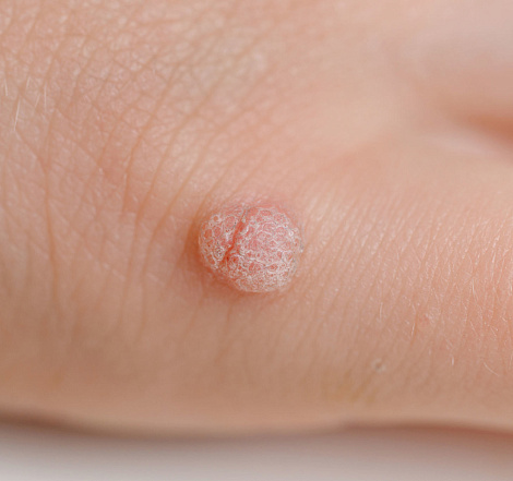 Удаление бородавок