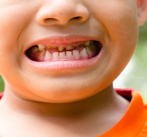 Зачем лечить молочные зубы, если они выпадут?