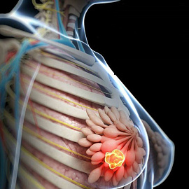 Рак молочных желез